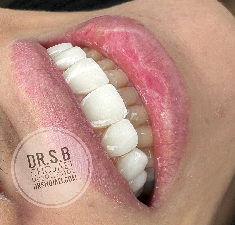 دکتر دندانپزشک کامپوزیت دندان شیراز
