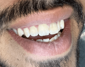 تصویر دندان های بیمار قبل از انجام کامپوزیت ونیر
